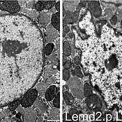 Elektronenmikroskopische Aufnahmen der Zellkerne von Herzmuskelzellen eines wildtypischen Mausherzen (links) sowie einem Herzen mit der LEMD2 Mutation (rechts). Die Einstülpungen der Zellkernmembran sind rechts deutlich sichtbar. 
