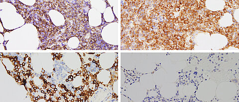 CD138-positive Myelomzellen, die vor der Behandlung mit Talquetamab das Transmembranprotein GPRC5D auf der Oberfläche tragen (oben). Beim Rezidiv nach der Behandlung mit dem bispezifischen Antikörper ist das Antigen verloren gegangen ist (unten).  