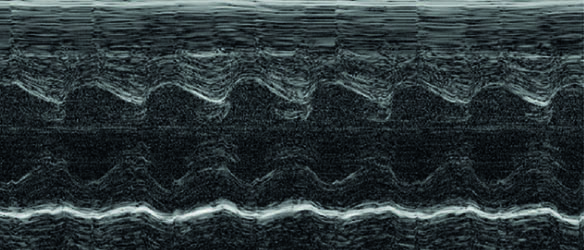 Echokardiogram 