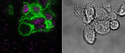 Primäre Myelom-Zellen in der Bildgebung: Links in der totalreflexionsfluoreszenzmikroskopischen Darstellung von zwei Oberflächenmarkern, rechts als Durchlichtmikroskopie-Bild.