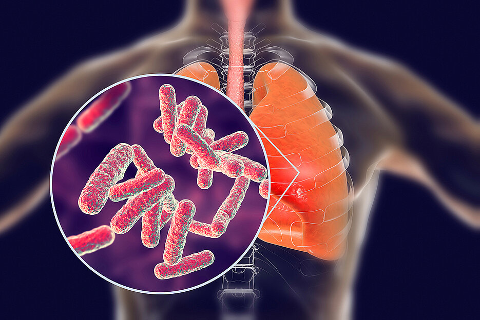 Tuberkulose ist eine hochansteckende Infektionskrankheit, die über den Luftweg übertragen wird und hauptsächlich die Lunge befällt. Jedes Jahr sterben geschätzte 1,7 Millionen Menschen weltweit daran.