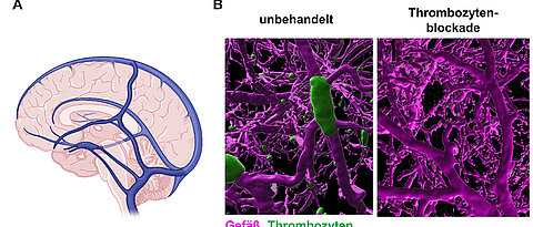 A)	Schematische Darstellung der großen Hirnvenen. B) Moderne Mikroskopieverfahren ermöglichen es, die Gerinnselbildung in den Hirnvenen von Mäusen darzustellen. Im linken Bild sind Gefäße einer erkrankten Maus zu sehen, wohingegen die rechten Bilder aus Mäusen stammen, deren Thrombozyten gehemmt wurden. (Bild: RVZ)