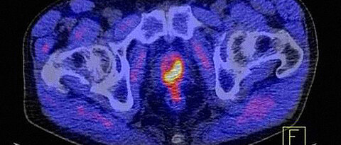 So markant kann Prostatakrebs mit dem Tracer PSMA als gelb-rotes Objekt dargestellt werden.
