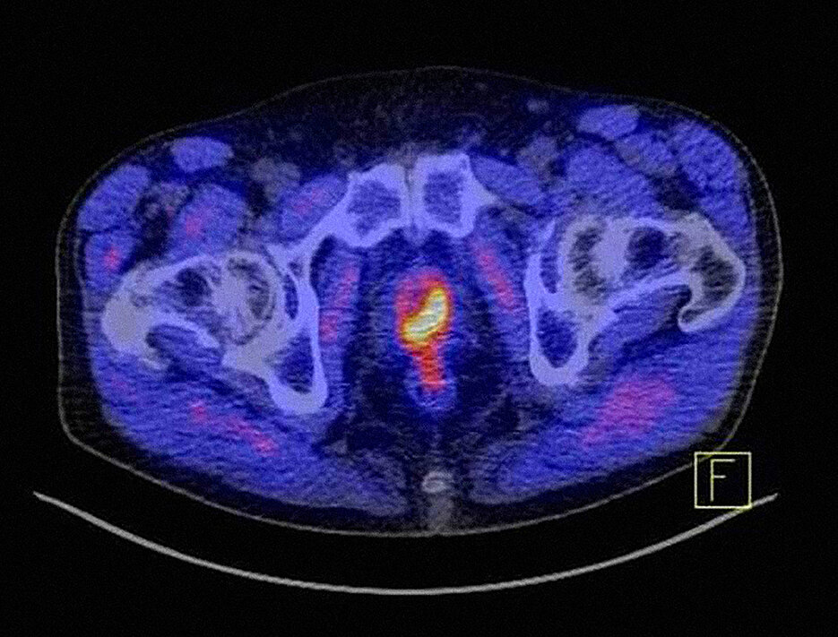 So markant kann Prostatakrebs mit dem Tracer PSMA als gelb-rotes Objekt dargestellt werden.
