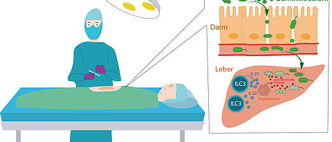 Nach einem operativen Eingriff können Bakterien aus dem Darm in den Organismus gelangen. Spezielle Zellen des Immunsystems, die in der Leber ansässig sind, bekämpfen sie. 