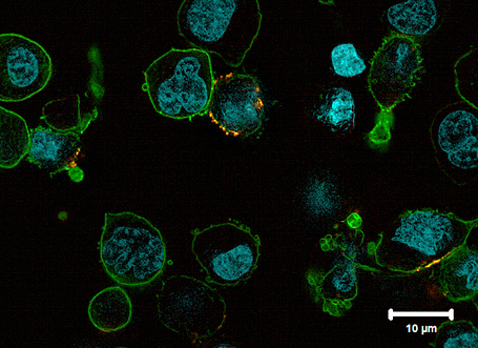 Eine Tumorzelle (links: blau gefärbter Zellkern, grün gefärbte Zelloberfläche) wird von einer umprogrammierten Immunzelle (rechts: gelb gefärbter synthetischer chimärer Antigenrezeptor – CAR) bekämpft.