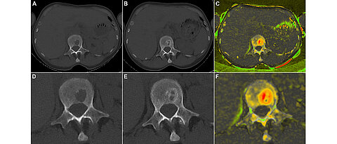 Darstellung des Therapieansprechens bei einer 62-jährigen Patientin mit multiplem Myelom (IgG kappa, R-ISS I). Die Baseline-CT zeigt einen Knochendefekt im ersten Lendenwirbel (A/D) mit trabekulärer Remineralisierung nach sechs Zyklen E-KRd (B/E). Eine farbkodierte Subtraktionskarte zeigt das Ausmaß der Remineralisierung in verschiedenen Teilen der Läsion (C/F). Obere Reihe: Standardansicht. Untere Reihe: Vergrößerung. ©Jan-Peter Grunz / MDPI (doi.org/10.3390/cancers15154008)