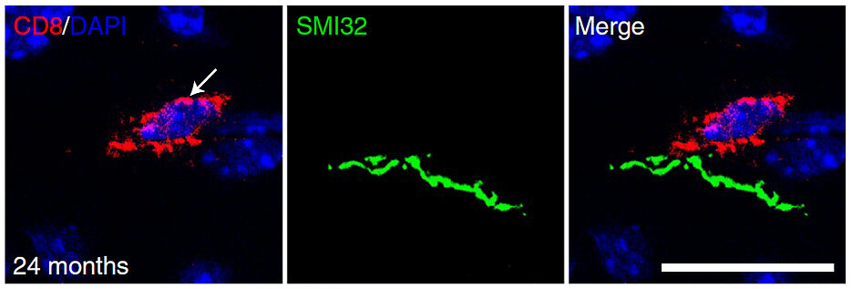 Mikroskopische Aufnahme einer CD8+ T-Zelle im zentralen Nervensystem einer zwei Jahre alten Maus. Die cytotoxische T Zelle (rot gefärbt) befindet sich in unmittelbarer Nähe zu einer geschädigten Nervenfaser (grün gefärbt) und ist laut den beschriebenen Forschungsergebnissen an ihrer Schädigung beteiligt. Die Zellkerne aller im Bild befindlichen Zellkörper sind blau gefärbt. Maßstab: 20 µm.