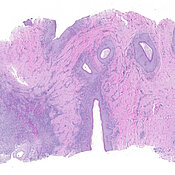 Das Gewebe einer Hidradenitis suppurativa (HS) im Stadium II–III wurde mit einer Hämatoxylin-Eosin-Färbung (HE-Färbung) histologisch untersucht