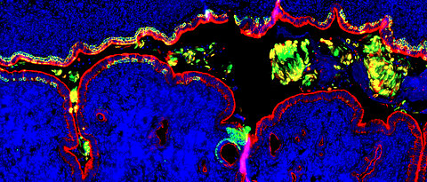 Das Bild zeigt Gewebe des Gebärmutterhalses, das mit Plattenepithelzellen (grün) ausgekleidet ist, die das endozervikale Säulenepithel (rot) ersetzen. Solche Plattenepithelgewebe sind sehr anfällig für die Besiedlung mit Krankheitserregern und die Entwicklung von Gewebeneubildungen 