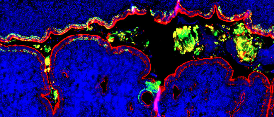 Das Bild zeigt Gewebe des Gebärmutterhalses, das mit Plattenepithelzellen (grün) ausgekleidet ist, die das endozervikale Säulenepithel (rot) ersetzen. Solche Plattenepithelgewebe sind sehr anfällig für die Besiedlung mit Krankheitserregern und die Entwicklung von Gewebeneubildungen 