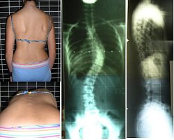 Patient mit verformter Wirbelsäule durch Skoliose