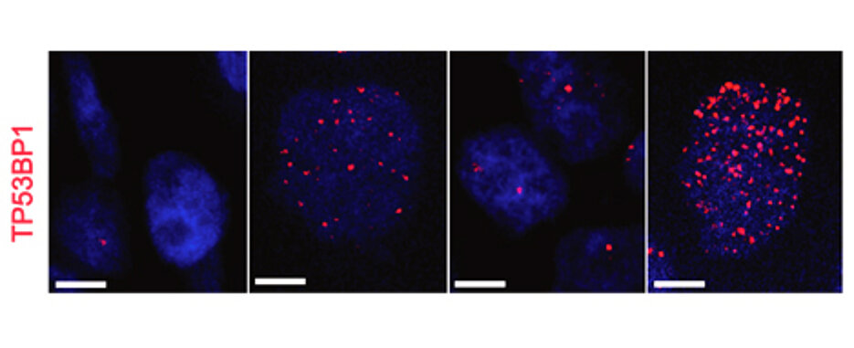 Das Bild zeigt den DNA-Schadensmarker TP53BP1 in Tumor-DNA. Das zweite Bild von links zeigt die Schäden an Tumorzellen, nach einer Behandlung mit Cisplatin. Das rechte Bild zeigt die Schäden an Tumorzellen, nach einer Reduktion von USP28 und einer Behandlung von Cisplatin. Es ist ein deutlicher Anstieg an Schäden an der Tumor-DANN zu beobachten.