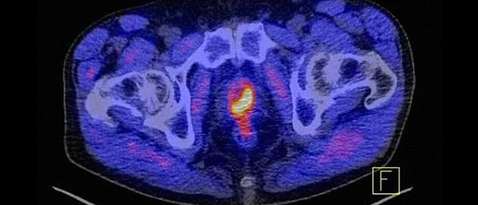 Am Informationstag haben Teilnehmende unter anderem die Chance, ihre Fragen über Prostata-Krebs (gelb-rot markiert) zu stellen.