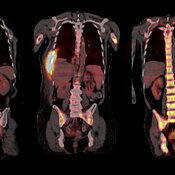 Zusätzlich zu den üblichen Knochenmarkproben aus dem Becken wurden für die Analyse der Myelomzellen bildgebende Verfahren wie hier die Positronen-Emissions-Tomografie (PET) genutzt, um gezielt Proben aus den Tumorherden zu nehmen.
