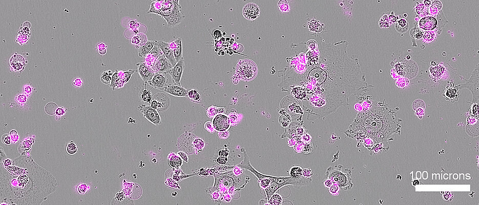 Nach einer Behandlung mit Cas12a2 sterben menschliche Gebärmutterhalskrebszellen (grau dargestellt) großflächig ab, erkennbar an den Apoptose-Markern (magenta).