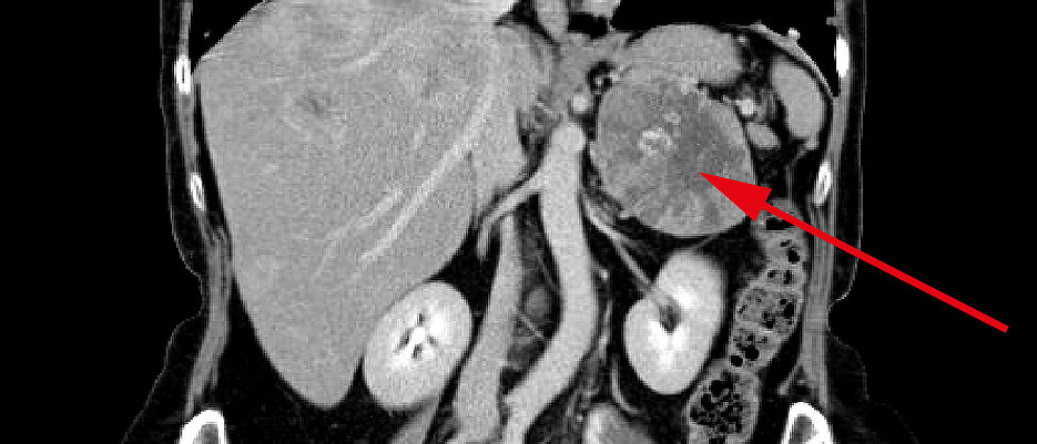 Elf Zentimeter großes linksseitiges Nebennierenkarzinom bei einer 57-jährigen Patientin. (Foto: Endokrinologie, Uniklinik Würzburg) 