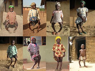 Kinder aus Nigeria mit sehr deformierten Beinen (Rachitis)