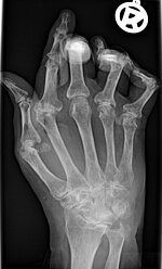 Röntgenaufnahme einer Hand mit verformten Fingern durch Rheuma