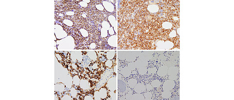 Die mikroskopischen Bilder zeigen CD138-positive Myelomzellen, die vor der Behandlung mit Talquetamab das Transmembranprotein GPRC5D auf der Oberfläche tragen (oben), das Antigen beim Rezidiv nach der Behandlung mit dem bispezifischen Antikörper jedoch verloren gegangen ist (unten). Oben links: Die entarteten Plasmazellen im Knochenmark wurden mit dem Oberflächenmarker CD138 gekennzeichnet. Oben rechts der Antigennachweis vor der Behandlung: Das braun markierte Zielantigen GPRC5D ist vielfach vorhanden. Unten links: Die Färbung des Oberflächenmarkers CD138 beim Rezidiv hat funktioniert und zeigt, dass, zahlreiche Myelomzellen vorhanden sind. Unten rechts: Das Zielantigen GPRC5D ist jedoch nach der Talquetamab-Behandlung verschwunden. © Andreas Rosenwald, Pathologie, Universitätsmedizin Würzburg