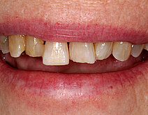 Ein Gebiss mit Lücken