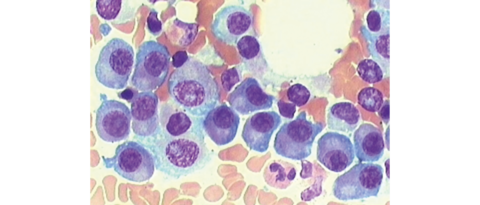 Bei gesunden Menschen sollte höchstens jede zwanzigste Zelle des Knochenmarks eine Plasmazelle sein. In diesem Knochenmarkausstrich eines Myelompatienten sind deutlich mehr violette Plasmazellen zu sehen. © UKW