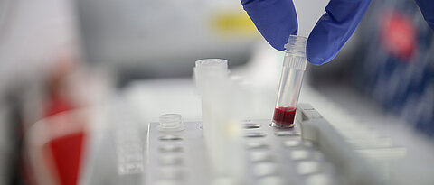 In Europa ist die molekulare Diagnostik bereits weit verbreitet, während die entsprechende individualisierte Behandlung noch ein Problem darstellt. Hier werden Blutproben für die automatische Aufreinigung von DNA vorbereitet.
