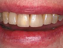 Ein Gebiss ohne Lücken