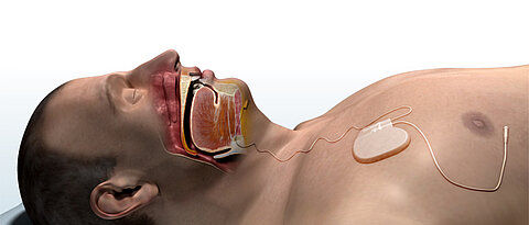 Ein Zungenschrittmacher hält im Schlaf die Atemwege offen.