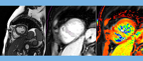 Kurzachsenschnitt durch das Herz. Links:  Mit dem klassischen Cine-MRT werden Struktur und Funktion des Herzens quantifiziert. Mitte: Beispiel einer Sequenz mit T2* Information. Eine Abnahme der in Millisekunden gemessenen T2* Zeit entspricht dabei einer Zunahme des Eisengehaltes. Rechts: Beim T2* Mapping wird durch Farbkodierung das Ausmaß der Veränderung von T2* über die Zeit visualisiert.