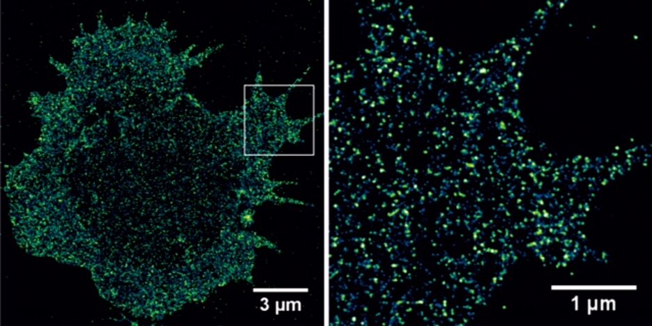 Mit der dSTORM Super-Resolution-Mikroskopie lassen sich Tumor-assoziierte Antigene auf primären Tumorzellen sichtbar machen und quantifizieren. (Bild: AG Markus Sauer)