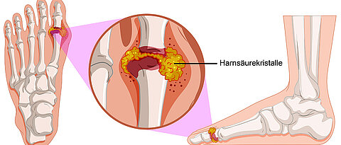 Bei der Stoffwechselerkrankung Gicht lagern sich Harnsäurekristalle an Gelenken ab und verursachen Entzündungen. 