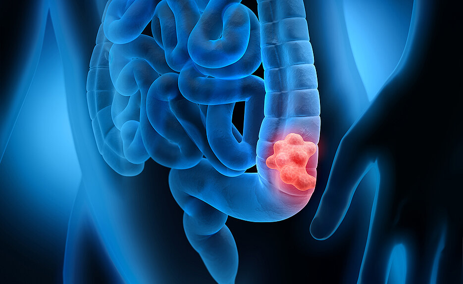 Tumoren am Dickdarm sind die zweit- bzw. dritthäufigste Tumorart bei Frauen und Männern.