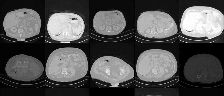 Erste Trainingsergebnisse: Aus zahlreichen echten Patientendaten wurden erste synthetische CT-Aufnahmen vom Abdomen erstellt. 