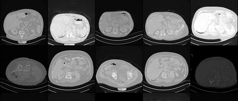 Erste Trainingsergebnisse: Aus zahlreichen echten Patientendaten wurden erste synthetische CT-Aufnahmen vom Abdomen erstellt. 