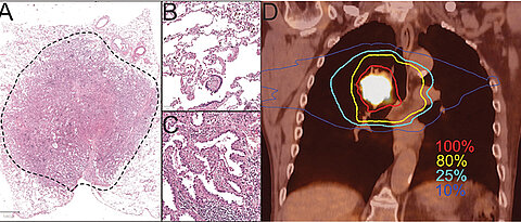 Links ein angefärbtes Adenokarzinom aus der Lunge. Der vergrößerte Ausschnitt B zeigt gesundes Lungengewebe, der vergrößerte Ausschnitt C ein Adenokarzinom. Unter D ist das PET-CT eines stoffwechselaktiven zentralen Lungentumors zu sehen, nahe an Luftröhre, Herz und Speiseröhre. Farbig dargestellt ist die Bestrahlungs-Dosisverteilung: Gewünschte Dosis 100% im Tumor und 80% im erweiterten Tumor-Bereich. 25% und 10% der Bestrahlungsdosis (türkise und blaue Linien) technisch bedingt im gesunden Gewebe.