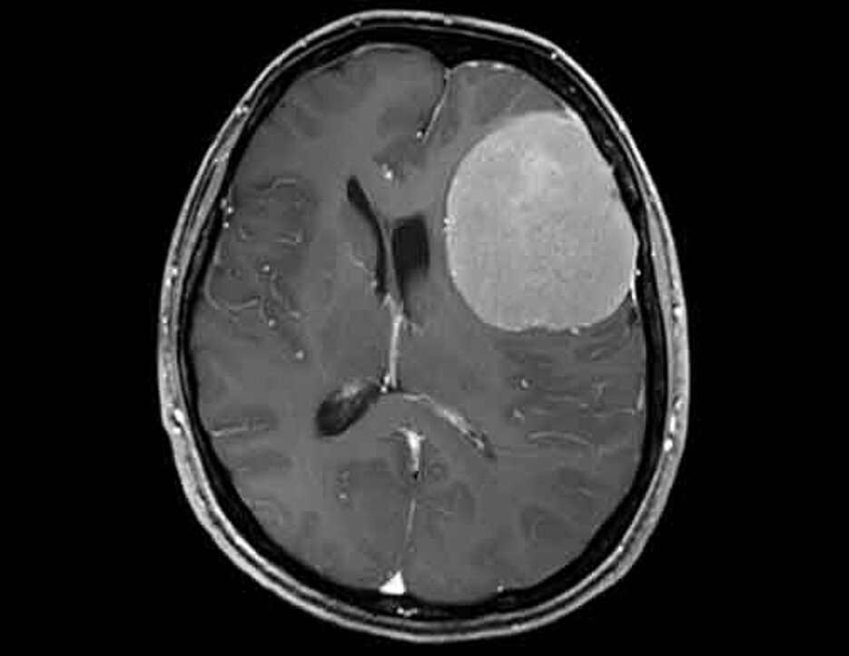 Hirntumor Wie Fing Es An www.med.uni-wuerzburg.de