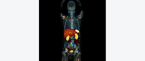 In dieser PET/CT-Aufnahme eines Patienten mit einem metastasiertem Phäochromozytom fallen neben der natürlichen Traceranreicherung in Leber, Milz, Nieren und Harnblase vor allem die zahlreichen Metastasen im Skelettsystem auf. © Nuklearmedizin, Universitätsklinikum Würzburg