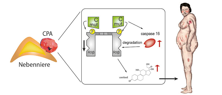 Bei einer Nebenniere mit eine gutartige Nebennierenadenom (links) ist der dem Protein-Kinase-A-Signalweg verändert (Mitte). Die Betroffenen entwickeln in der Folge die typischen Cushing-Syndrom-Merkmale.